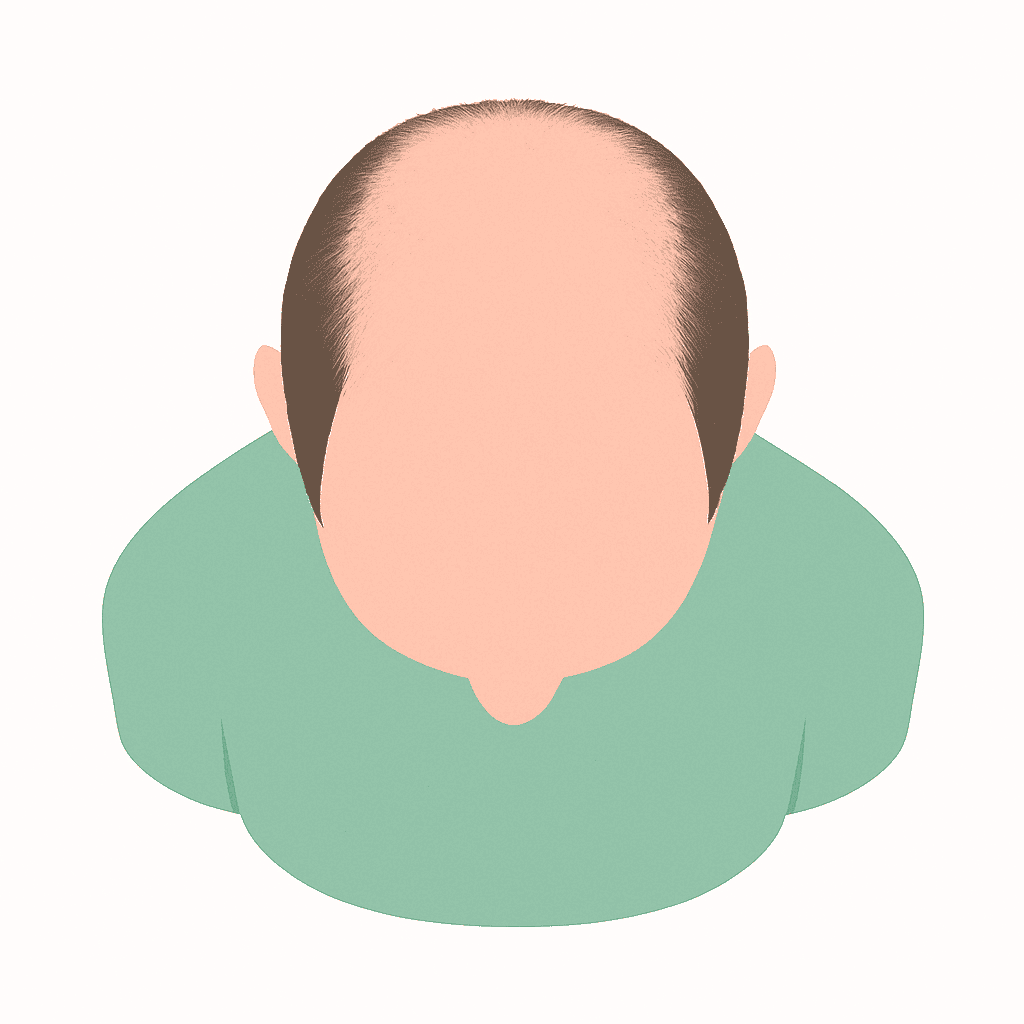 Final results of hair transplant treatment