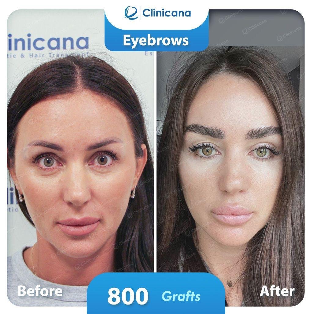 eyebrows transplant
