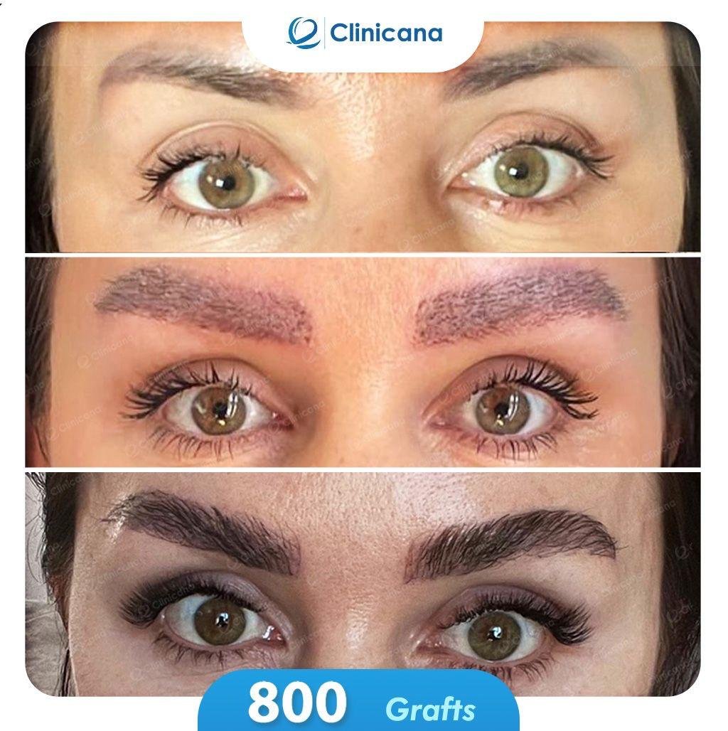 eyebrows transplant