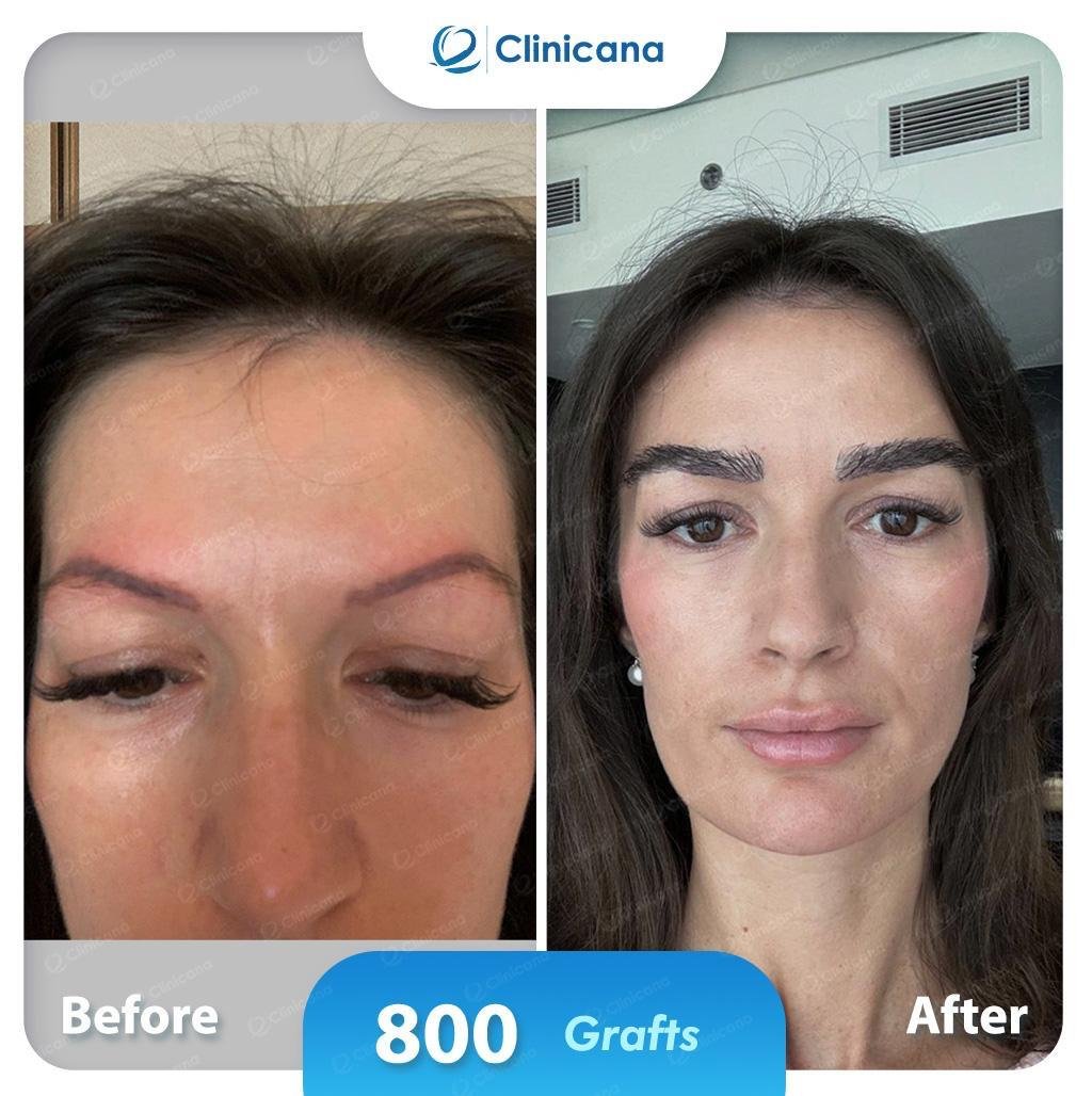eyebrows tranplant