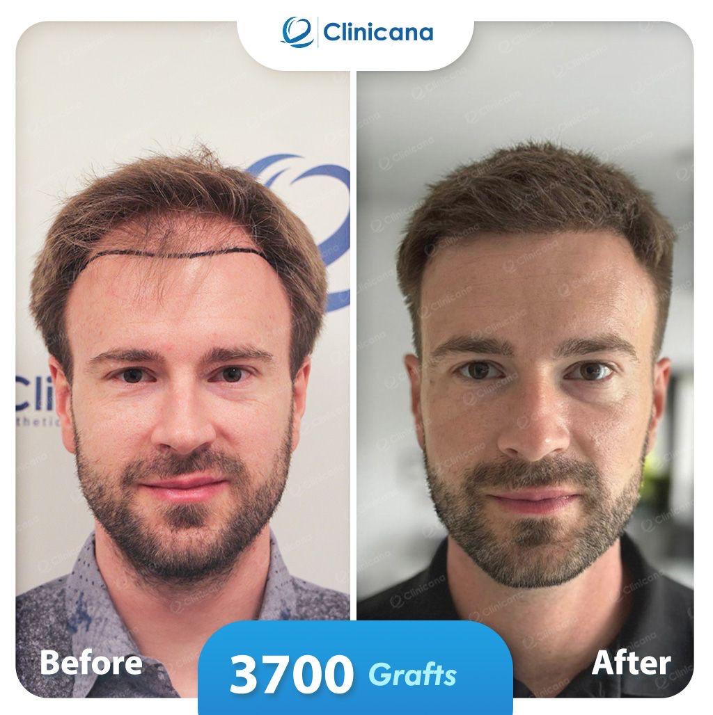 hair transplant man