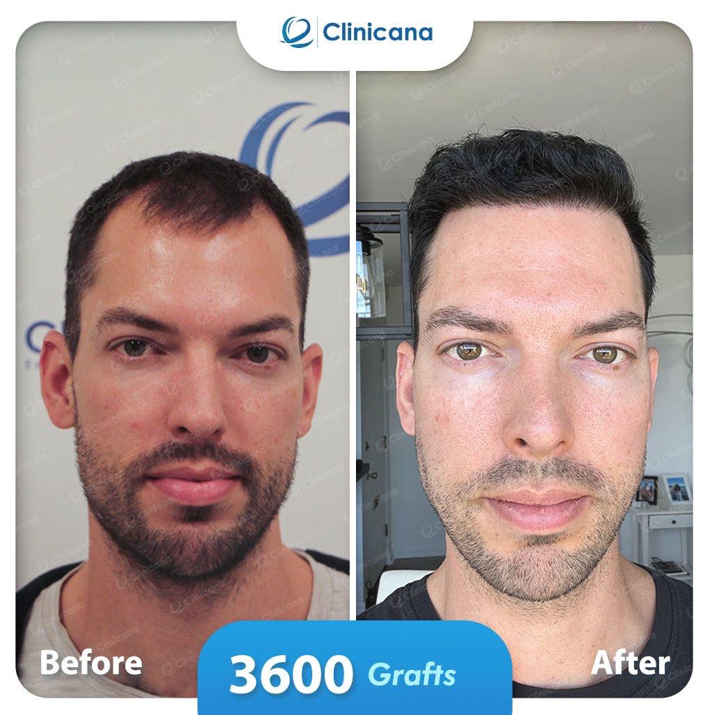 hair transplant man
