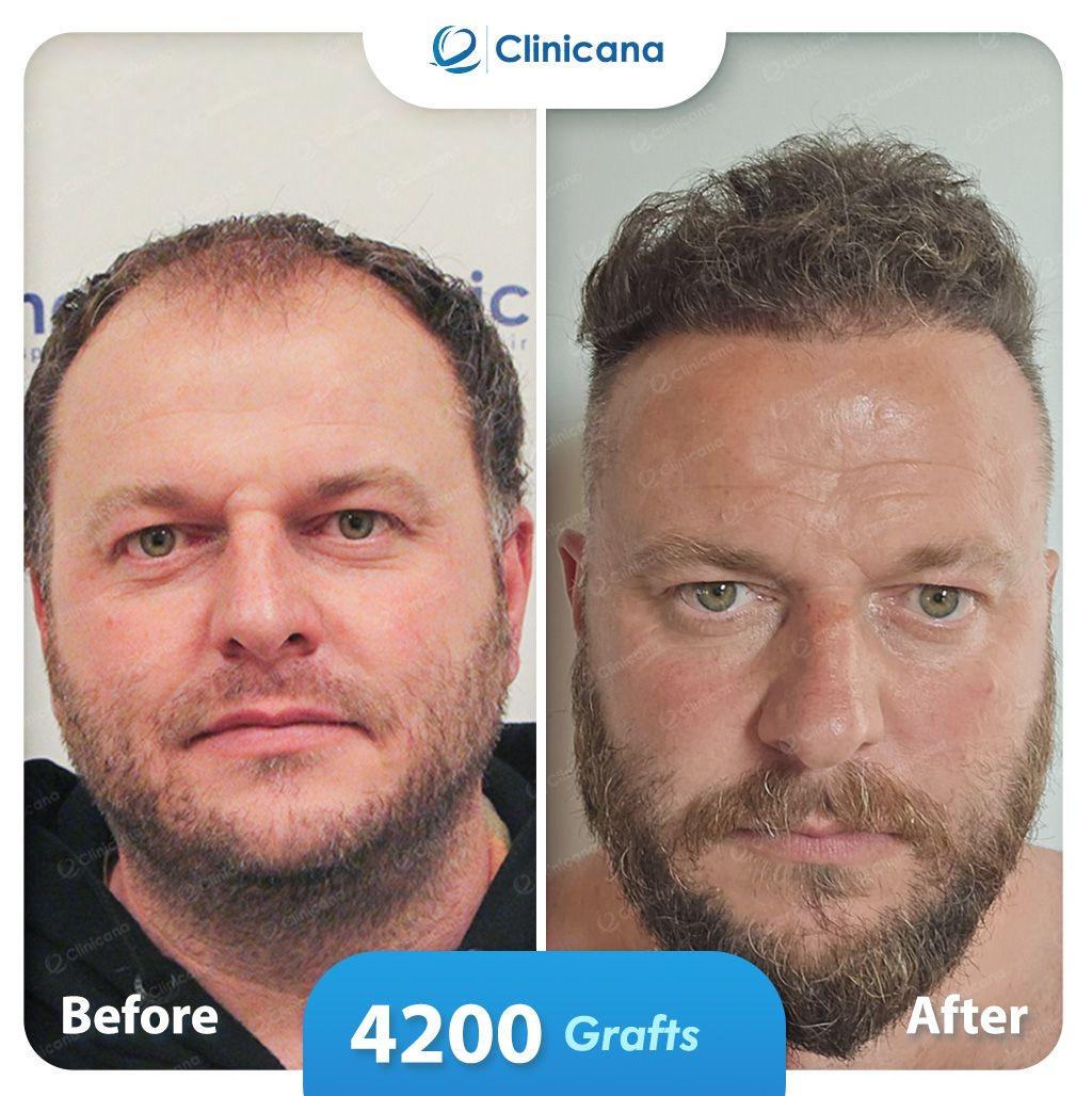 hair transplant man