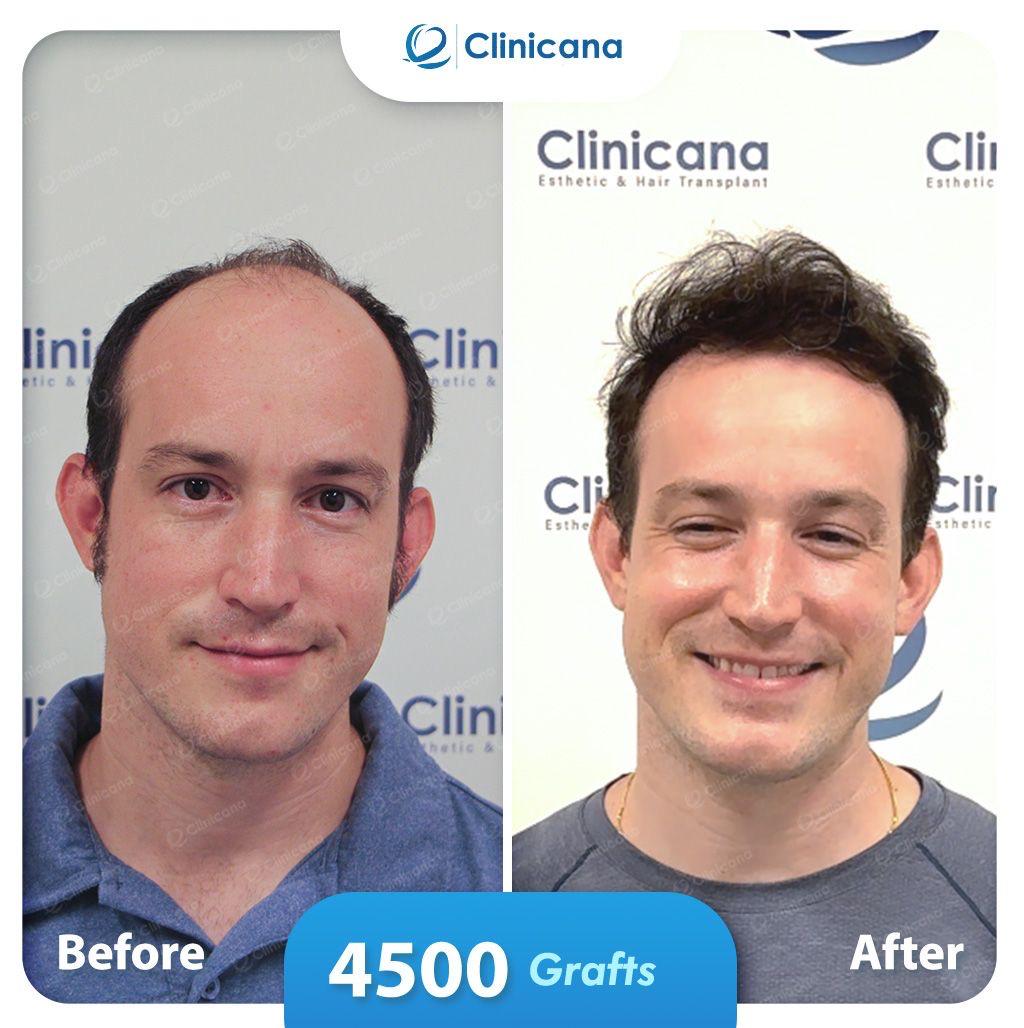 hair transplant man