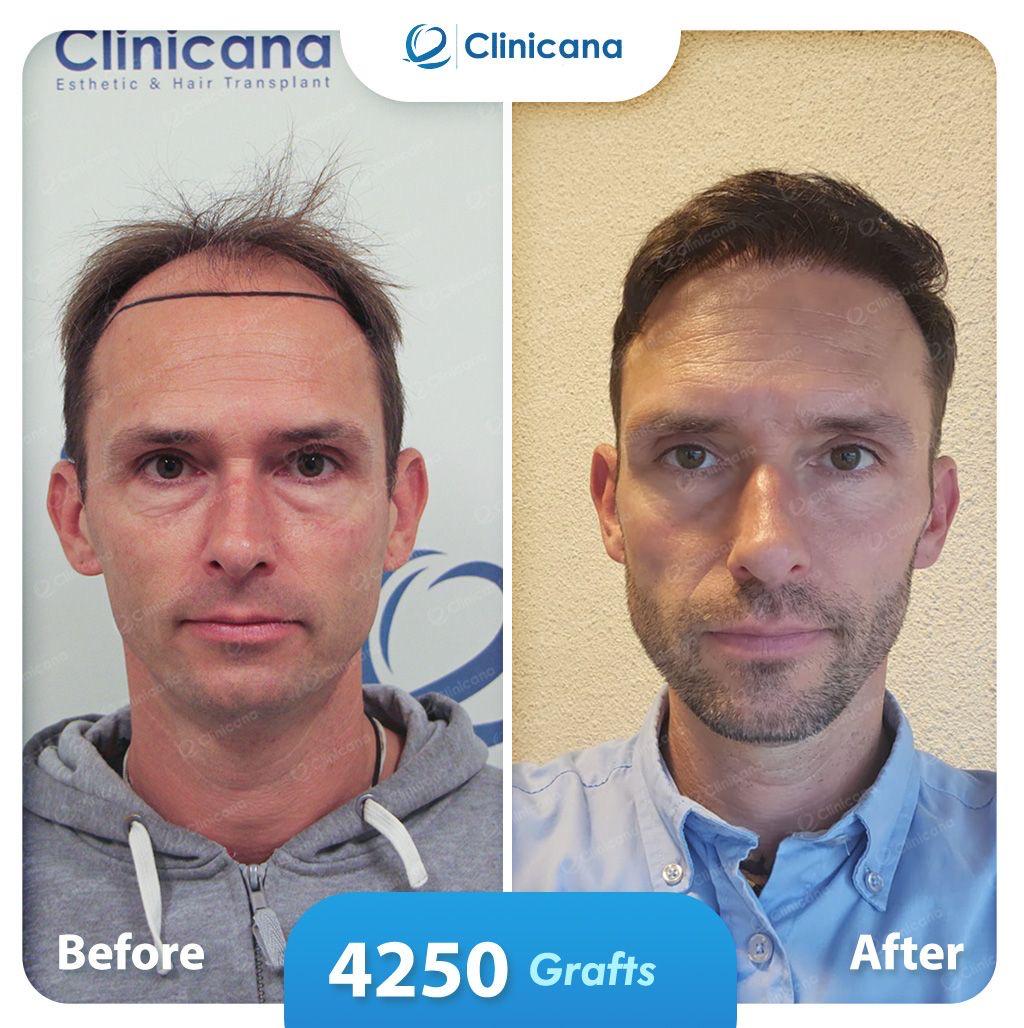 hair transplant man