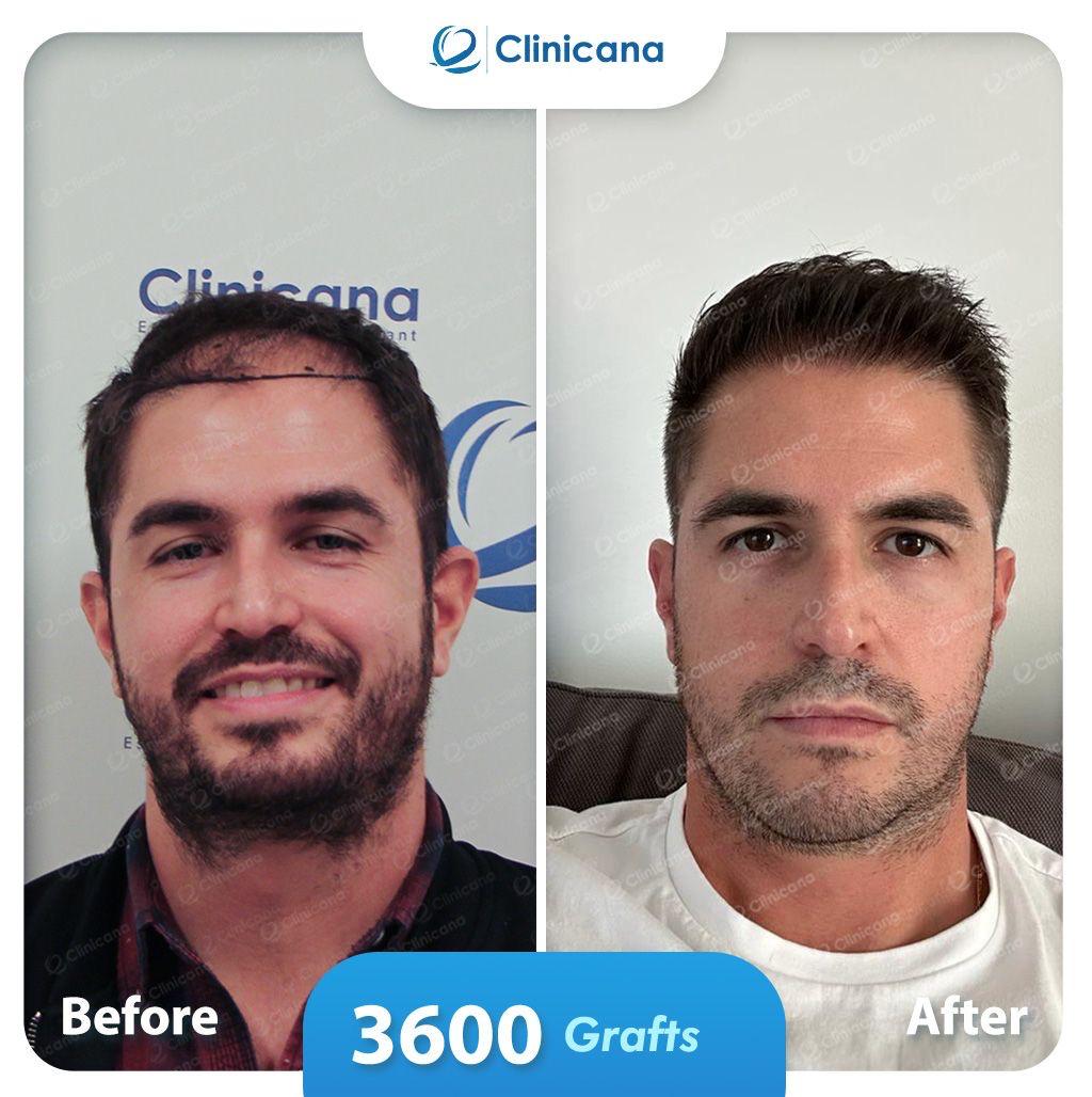 hair transplant man
