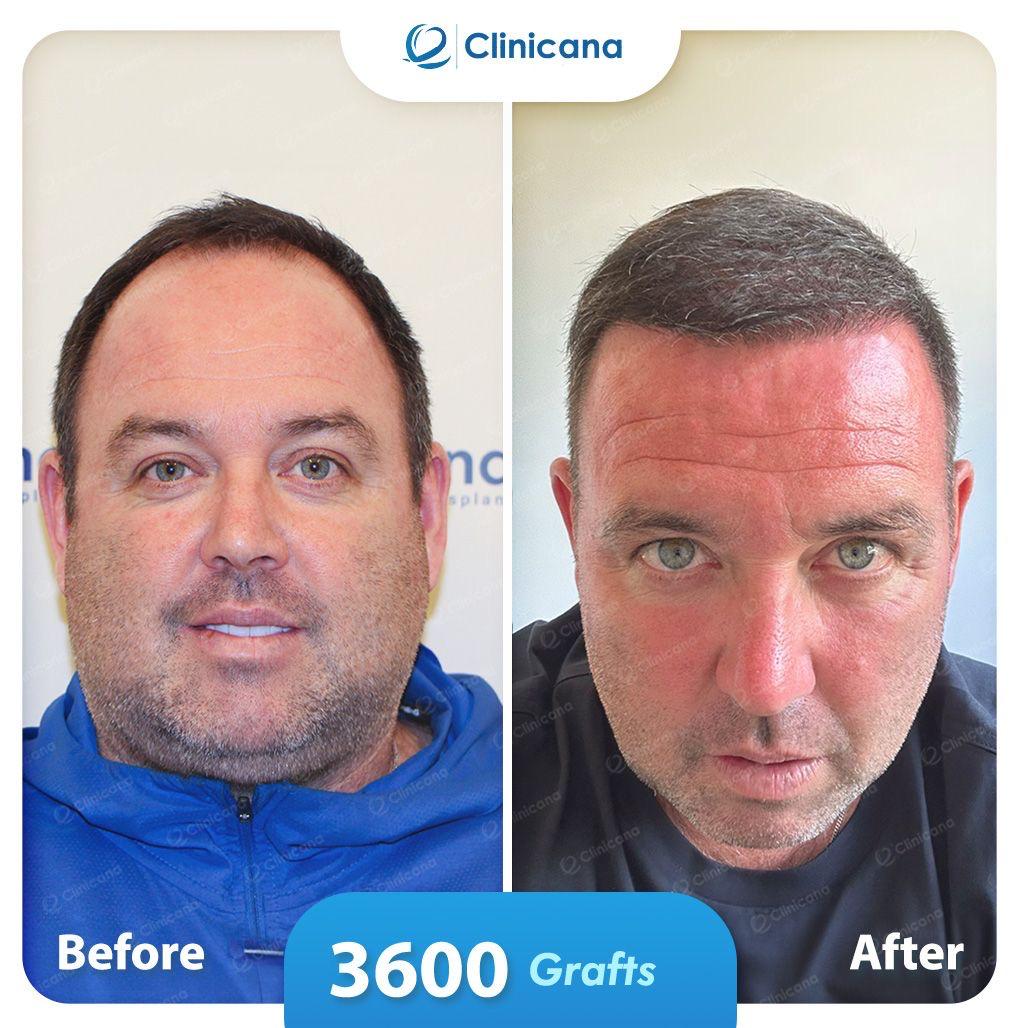 hair transplant man