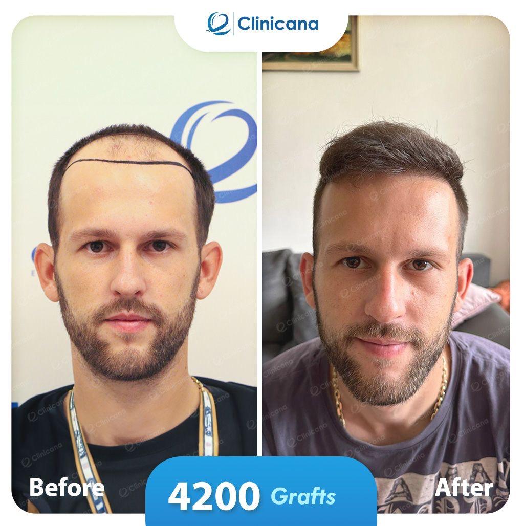 hair transplant man