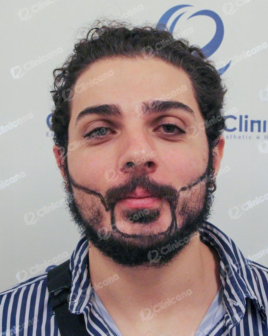 Beard_img_1_before