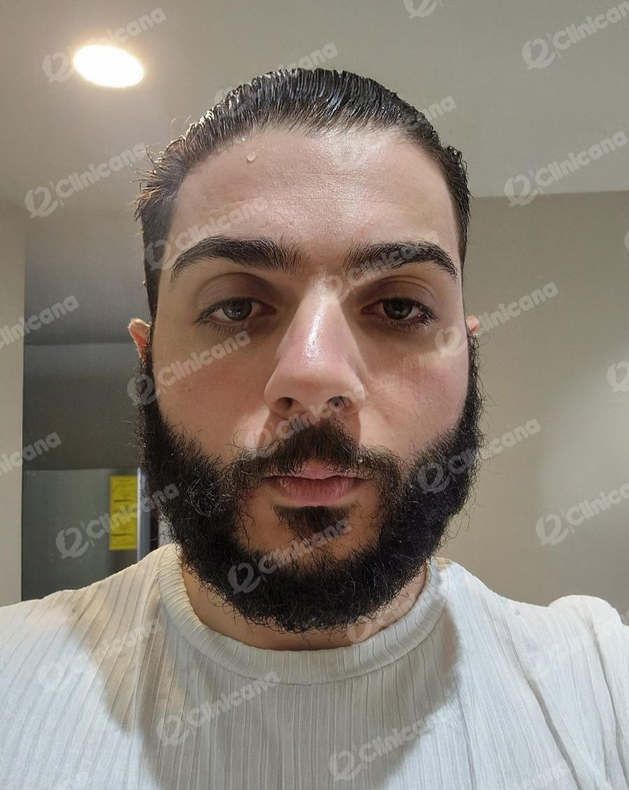 Beard_img_1_after