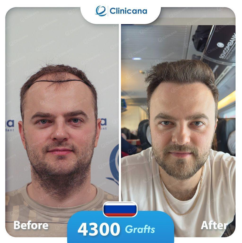 hair transplant man
