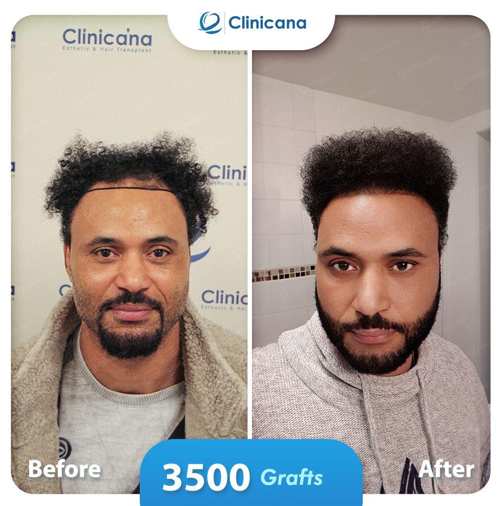 hair transplant man