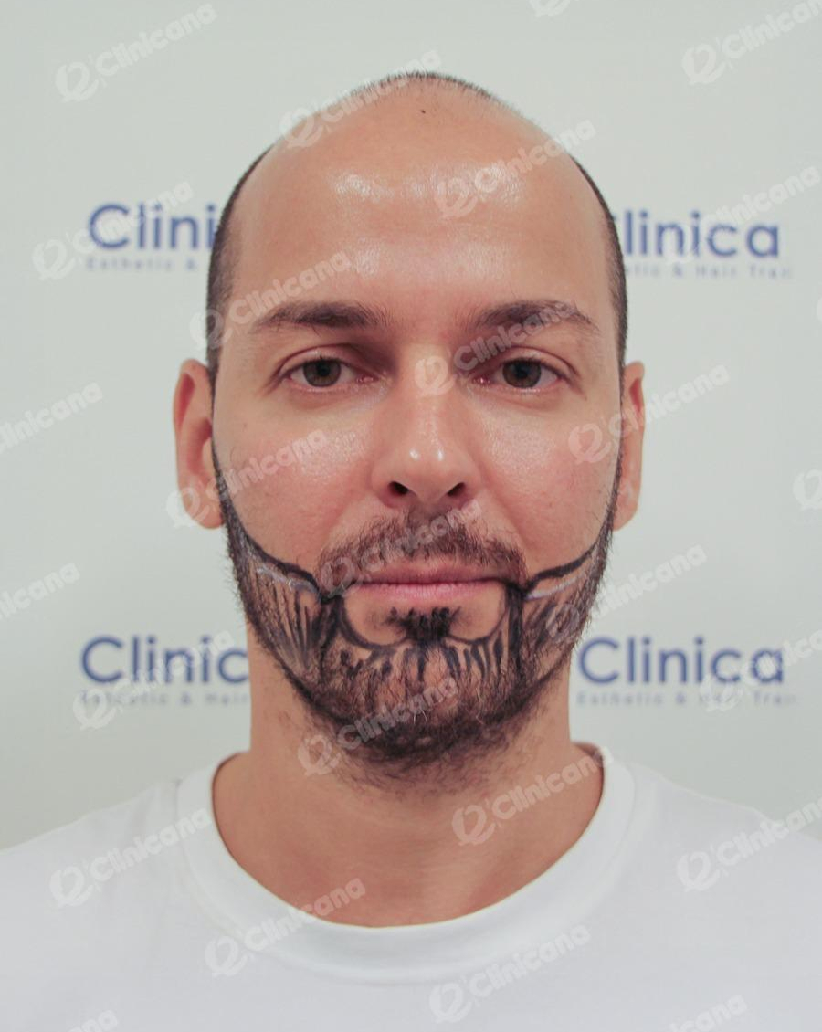 Beard_img_2_before